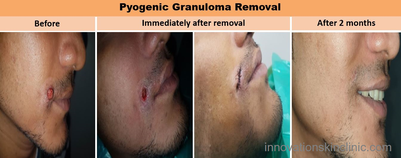 Surgeries For Benign Skin - Pyogenic granuloma Removal